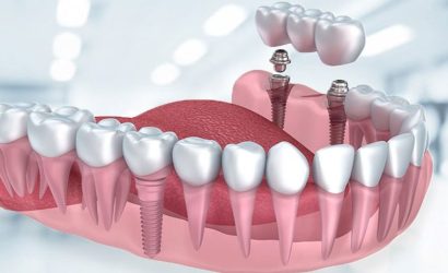 implant